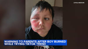 TikTok Trend: NeeDoh Cube Causes Severe Burns to Boy