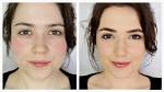 Rosacea Makeup on Pinterest Acne Makeup, Rosacea Treatment