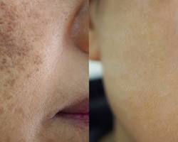 Image of Carbon laser treatment sun damage