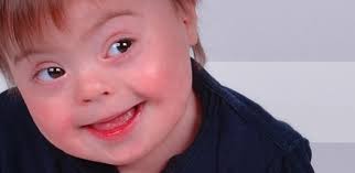 Resultado de imagem para sindrome de down