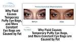 Periorbital puffiness - , the free encyclopedia