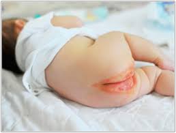 Image result for newborn diaper rash