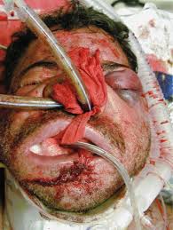 Image result for facial injury