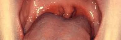 Image result for tonsil stones
