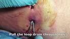 250ml Pus Drained - Abscess -