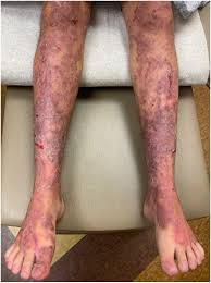 Pregnancy-associated blistering in a patient with junctional ...