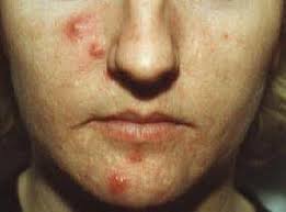 Znalezione obrazy dla zapytania Cysta