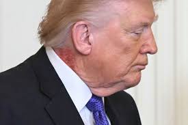 trump neck rash Picture