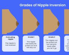 Image of comparison between a normal nipple and an inverted nipple