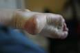 Les ampoules et les cloques des pieds et des talons comment les