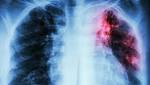 Roughly 200 People Potentially Exposed to Tuberculosis in Corona