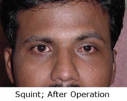 英和画像辞典：(squint)の関連画像一覧！