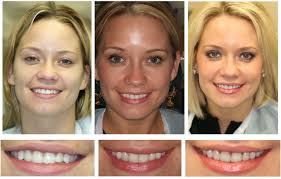 Vì sao nên bọc răng sứ tại nha khoa Tân Bình Images?q=tbn:ANd9GcScKy10LI1HiOkrfMUNls3C7zHcUob1-OqTPBH7iWGjvegH9nme