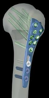ALIANS PROXIMAL HUMERUS