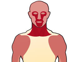 Image of Myasthenia gravis muscle
