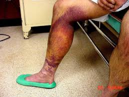 Résultat de recherche d'images pour "copperhead bites"