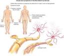 Syndrome de guillain barre