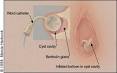 Drainage of bartholin cyst