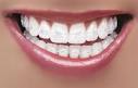 Clear Ceramic Braces Q A with HD Close up -