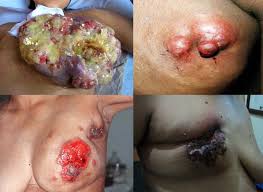 Image result for kanker