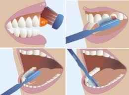 Resultado de imagen para los dientes y las caries y como pueden prevenirse