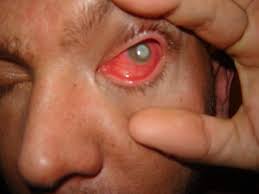 Résultat de recherche d'images pour "eye infection"