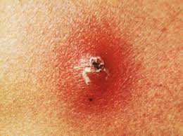 Image result for carbuncle