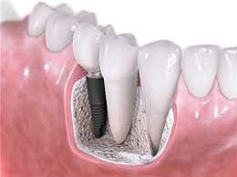 Image result for Calcium Magnesium Silicate Ceramics