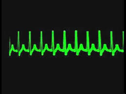 Resultado de imagen para taquicardia