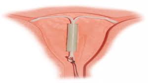 Image result for IUD image
