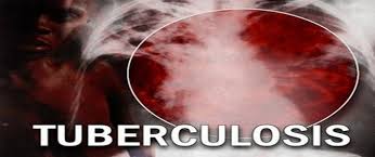 Image result for images of tuberculosis lungs