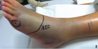 Image result for snake bite drug