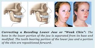 Image result for jaw surgery