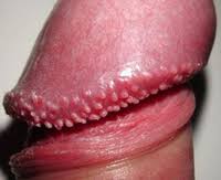 Znalezione obrazy dla zapytania hpv na prąciu