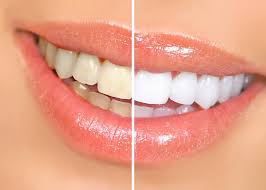 Resultado de imagem para CLAREADOR DENTAL