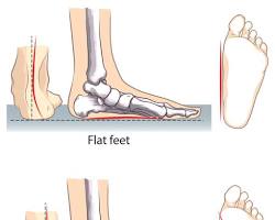 Flat feet