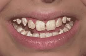 Image result for fluorosis