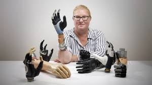 Bionic Hand Innovation: Groundbreaking Integration with Woman’s Bones, Muscles, and Nerves