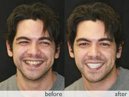 View all the before and after smile transformations below. To view each patient case by case click here. - alexis-snap-on-smile-head