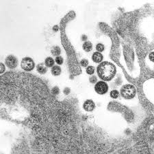 U.S. death from Lassa fever, an Ebola-like virus, is reported in Iowa