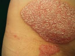 Image result for PSORIASIS