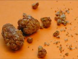 Resultado de imagem para Pedra de acido urico