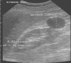 Znalezione obrazy dla zapytania Cysta