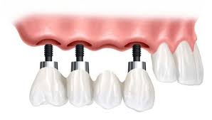 Kết quả hình ảnh cho Cay ghep Implant o dau tot nhat ha noi