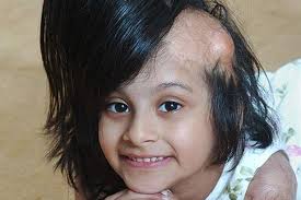 BRAVE schoolgirl Sidra Afzal went back to school yesterday after doctors grew her a new head of hair to hide horrific burns. Share; Share; Tweet; +1; Email - image-1-for-paper-pics-11111-gallery-659268714-103458