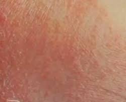Image result for sweat itch
