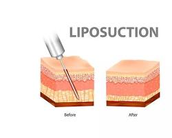 Image of Traditional Liposuction procedure