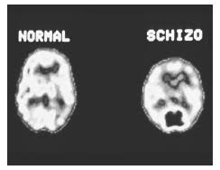 schizophrenia, crisis management