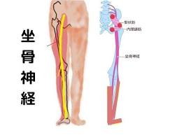 坐骨神経痛の筋力低下の画像