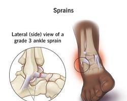 Image of Grade 1 ankle sprain